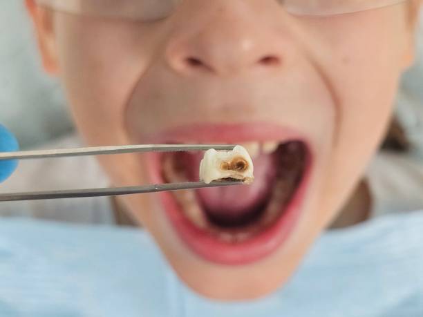 Best Emergency Broken Tooth Repair in Katonah, NY