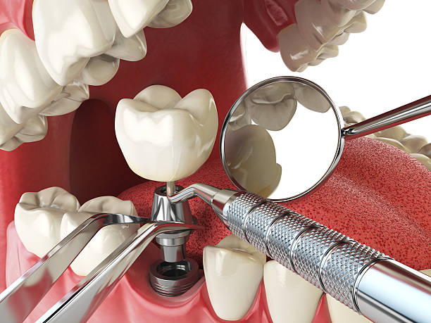 Best Emergency Tooth Extraction in Katonah, NY